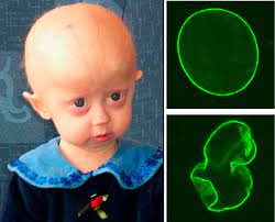 Hutchinson-Gilford Progeria syndrome is a rare genetic disease involving accelerated aging